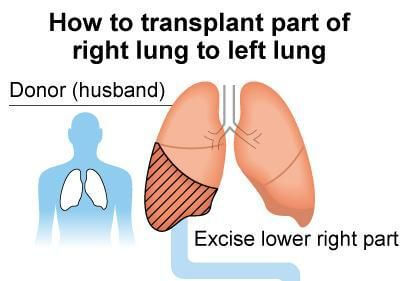Lungentransplantation
