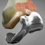 ConforMIS – Individuelle Knieprothesen aus dem 3D-Drucker