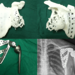 Schulterblatt aus dem 3D-Drucker