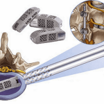 EndoLIF® joimax®-Implantat