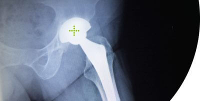 Implantierter neuer Hüftgelenkskopf. 