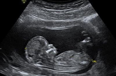 Ultraschallbild eines Fötus.