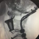 Implantierte Wirbelkörper.