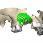 Oberkiefer aus dem 3D-Drucker