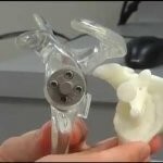 Schulterimplantat aus dem 3D-Drucker