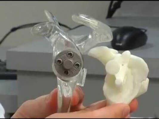 Schulterimplantat aus dem 3D-Drucker