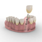 3D-Visualisierung von Zahnimplantat