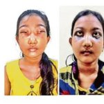 Bibhabari Samal vorher und nachher