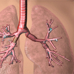 Animation wie der Stent funktioniert