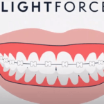 Lightforce Zahnspange aus 3D-Drucker