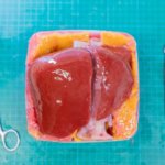 3D-gedrucktes Lebermodell und medizinische Werkzeuge