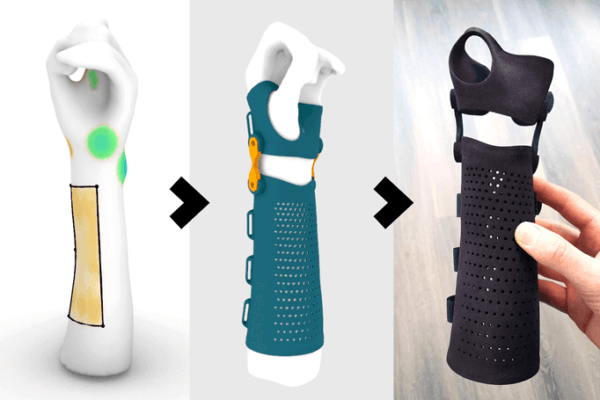 Vom 3D-Scan zur fertigen Orthese