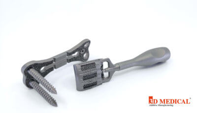 3D-gedruckte Halsimplantate