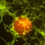 Gewebemodell eines Tumors