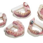 3D-gedruckte Zahnmodelle