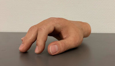 Funktionalität und Ästhetik in der Hand- und Armprothetik mit 3D-Druck Hand aus dem 3D-Drucker