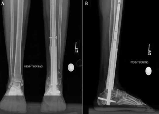 Schienbeinknochen aus dem 3D-Drucker Schienbeinknochen aus dem 3D-Drucker