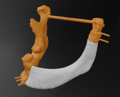 Modell des 3D-gedruckten Implantats