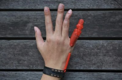 Hand mit 3D-gedruckter Fingerprothese