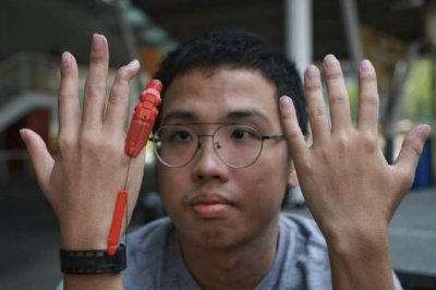 Patient hält beide Hände in die Kamera, eine davon mit 3D-gedruckter Fingerprothese