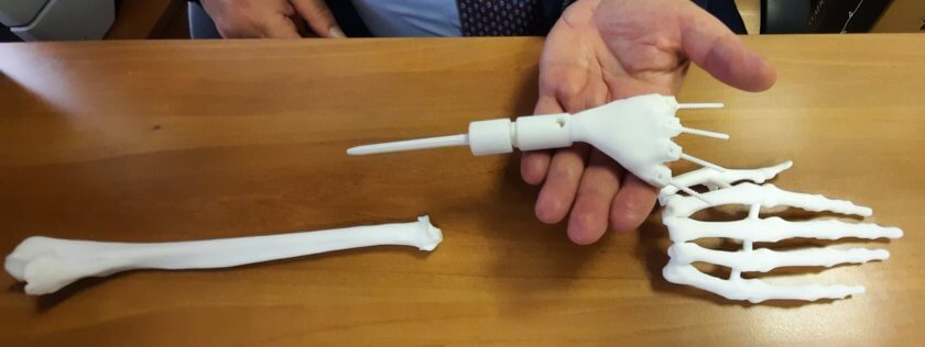 Prototyp der Handprothese