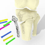 Knieimplantate aus dem 3D-Drucker
