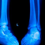 Röntgenbild eines Knöchels mit Hinweis auf 3D-Druck Implantationsfall.