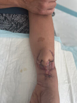 3D-gedruckte Nase, entwickelt am Unterarm einer Patientin in Frankreich