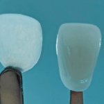 3D-gedrucktes UltraThineer Zahnveneer von Boston Micro Fabrication