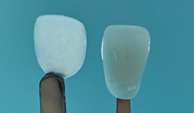 3D-gedrucktes UltraThineer Zahnveneer von Boston Micro Fabrication