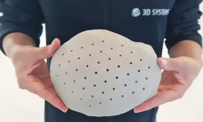3D-gedrucktes Schädelimplantat von 3D Systems - Technologie für medizinische Anwendungen Patientenspezifisches Schädelimplantat hergestellt mittels 3D-Druck von 3D Systems aus Evonik VESTAKEEP Material