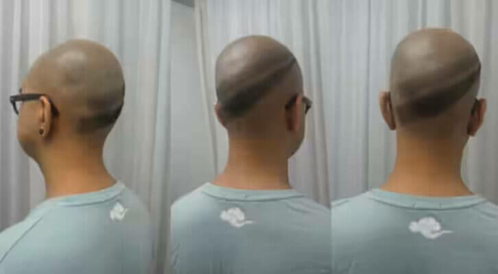 Patient nach Behandlung mit 3D-gedruckten Haarfollikeln zur Haarausfall-Therapie, ein Durchbruch in der regenerativen Hautmedizin