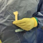 Chirurg hält ein 3D-gedrucktes Handgelenksimplantat, das im South Warwickshire University NHS Foundation Trust eingesetzt wurde