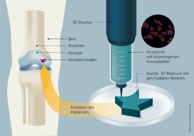 3D-Biodruck von Knieknorpelimplantaten zur Reparatur von beschädigtem Knorpel