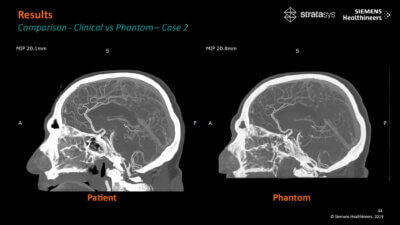 CT-Vergleich: Patientenspezifisches 3D-gedrucktes Phantom vs. klinischer Scan Medizinischer CT-Scan-Vergleich zwischen einem realen Patientenbild und einem 3D-gedruckten Phantom von Stratasys und Siemens Healthineers