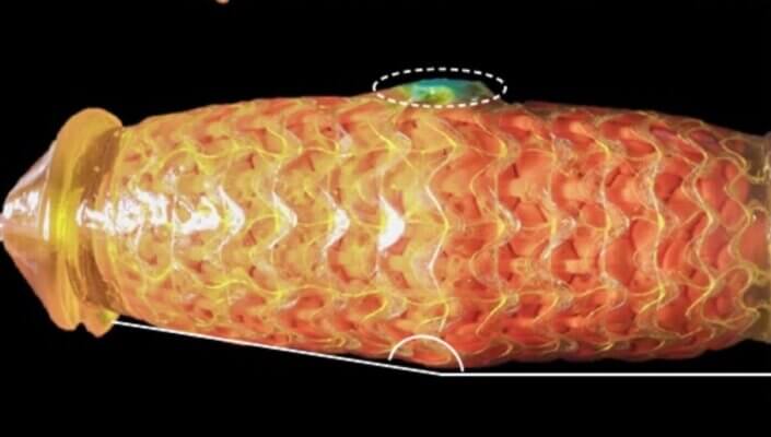 Grafische Darstellung des Mechanismus einer durch Arteriosklerose bedingten erektilen Dysfunktion, bei der verengte kavernöse Arterien die Expansion der Schwellkörper behindern.