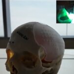 Ärzte in New Jersey retten mit 3D-Druck Leben eines Patienten – Schädel rekonstruiert