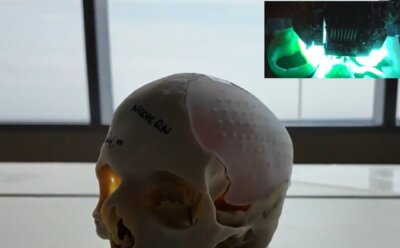 3D-gedrucktes Schädelimplantat für chirurgische Rekonstruktion Nahaufnahme eines 3D-gedruckten Schädelimplantats mit personalisierter Passform für einen Patienten