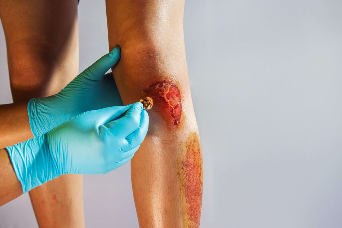 Nahaufnahme einer Brandverletzung am Bein während einer medizinischen Behandlung mit Handschuhen und Tupfer