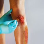 Nahaufnahme einer Brandverletzung am Bein während einer medizinischen Behandlung mit Handschuhen und Tupfer