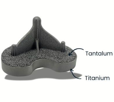3D-gedrucktes medizinisches Bauteil mit porösem Tantal auf Titan-Basis zur verbesserten Knochenanbindung